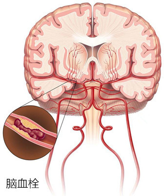 从发病机理上讲,脑血栓主要是由脑血管病变造成脑血管阻塞所致;脑栓塞