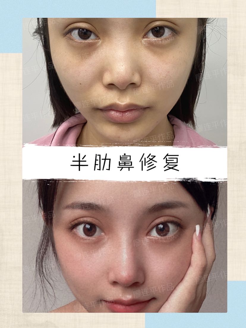 大家好,今天来给大家做一个挛缩鼻修复的案例分析