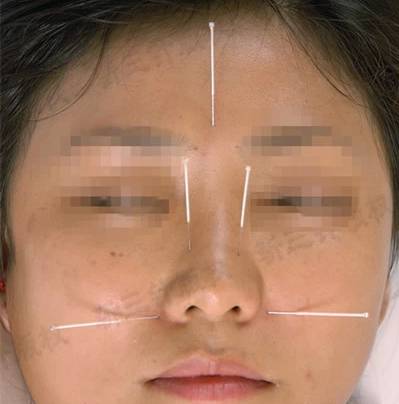 上迎香:在面部,当鼻翼软骨与鼻甲的交界处,近鼻唇沟上端处.