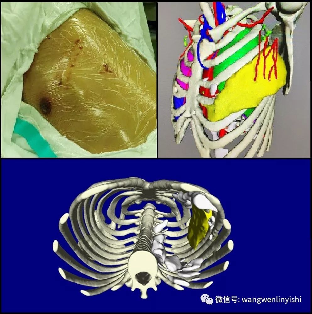 图3,此患者为窒息性胸廓畸形(jeune综合征)患者,胸壁结构极度变形