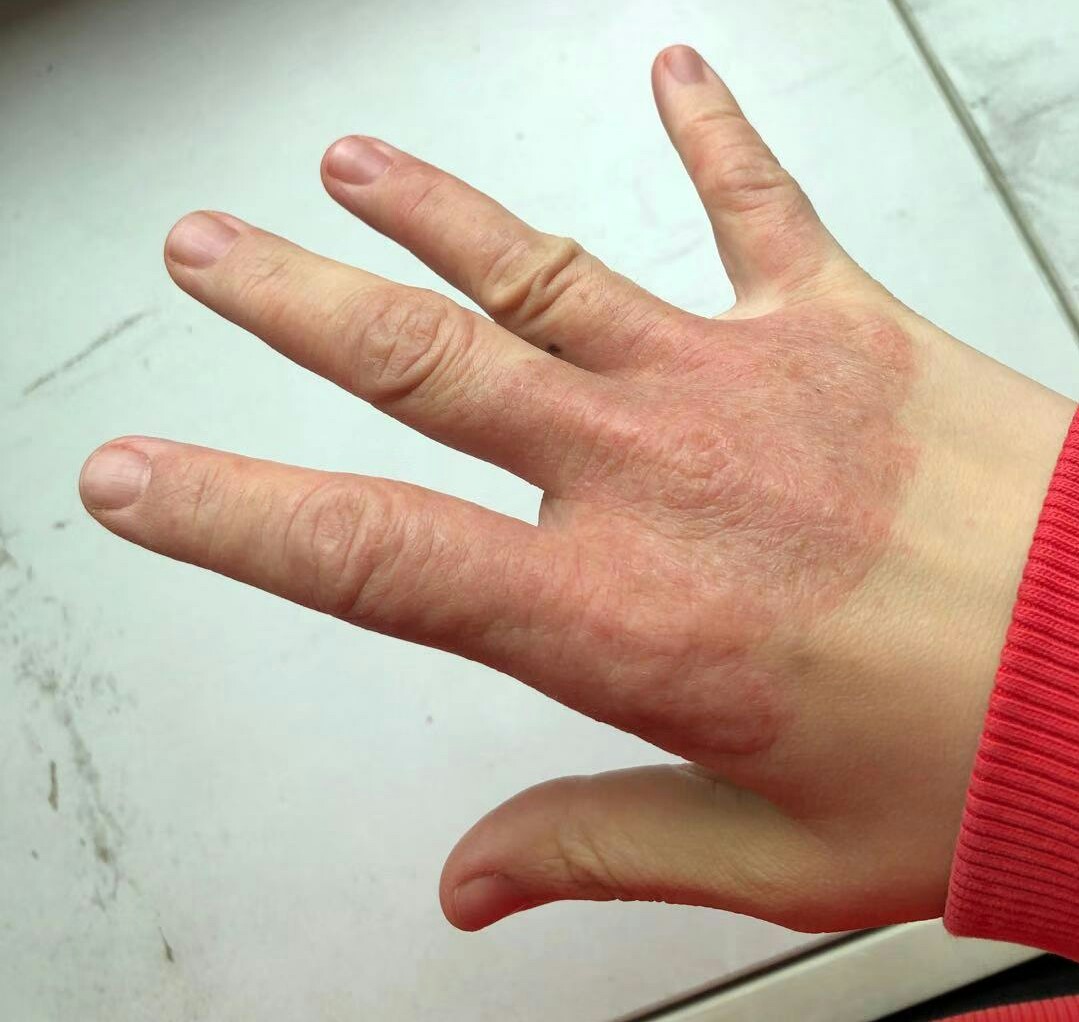 手背红斑瘙痒2个月用药1周见神效是什么皮肤病