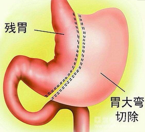缩胃手术有助于治疗痛风!