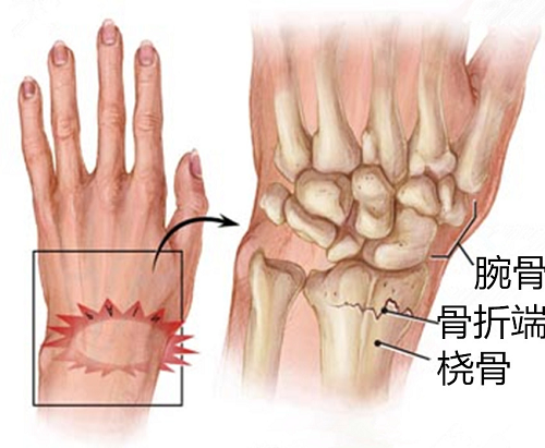 过年的骨科故事手腕受伤了该怎么办