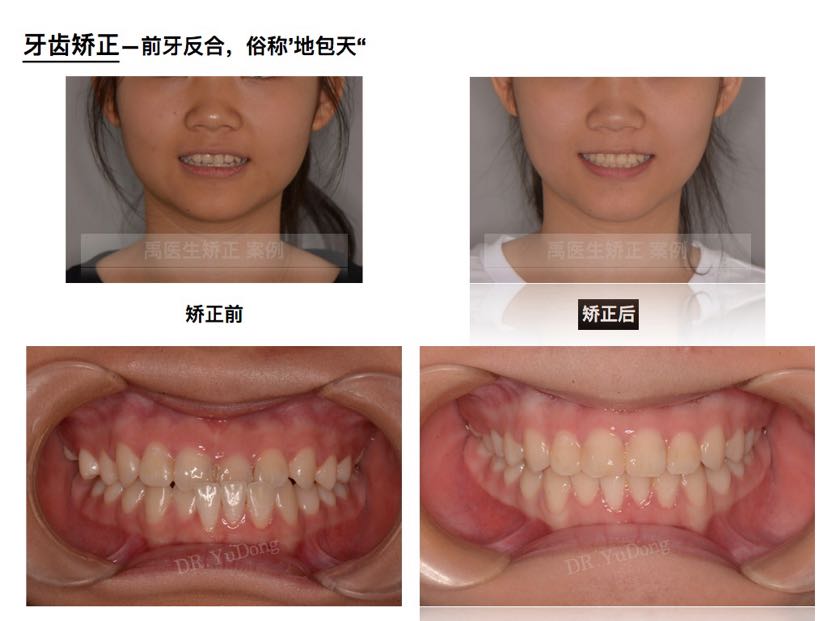 前牙反合案例一例:俗称"地包天"矫正