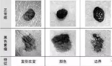 即是用四个象征来区别其不同点  生活中,如何预防黑色素瘤的蔓延和