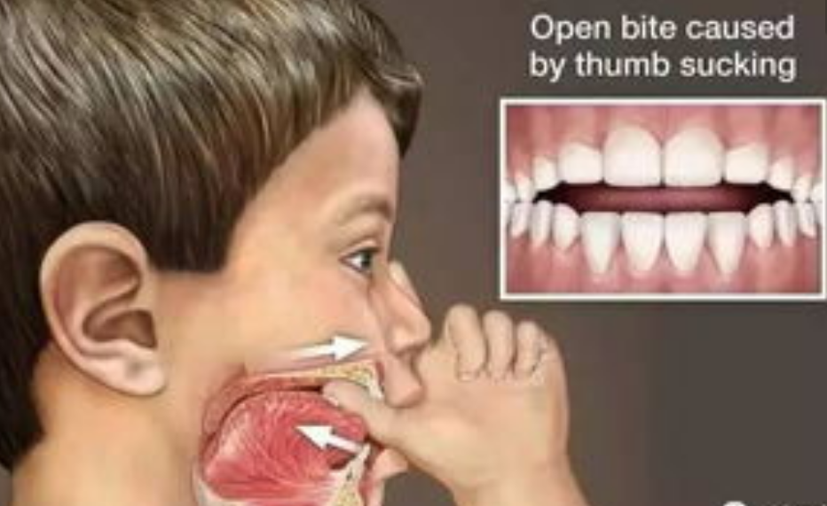 舌头位置不正确 舌位置正常的人是舌头是顶在上颚的,舌头抵住上颚