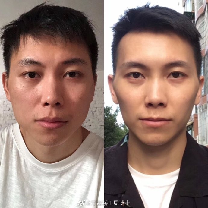只是带了个牙套