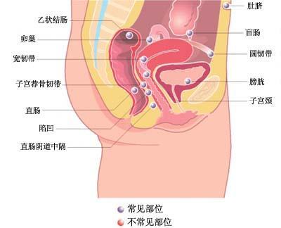 在体检时尤其进行阴道,直肠三合诊时会发现子宫后位,固定而且在阴道