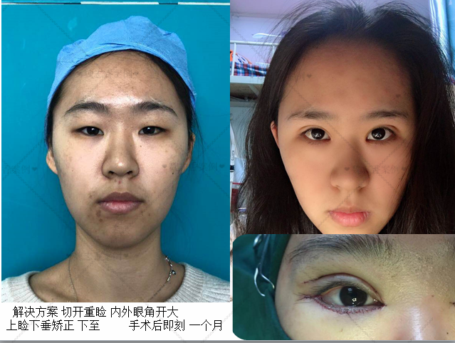 1,眼睑下至之矫正眼裂短小