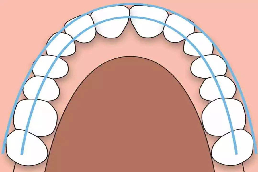 牙齿矫正之扩弓篇