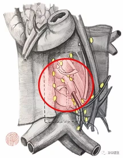 医学笔记|肠系膜下动脉主淋巴结的清扫(附:彩色图谱)