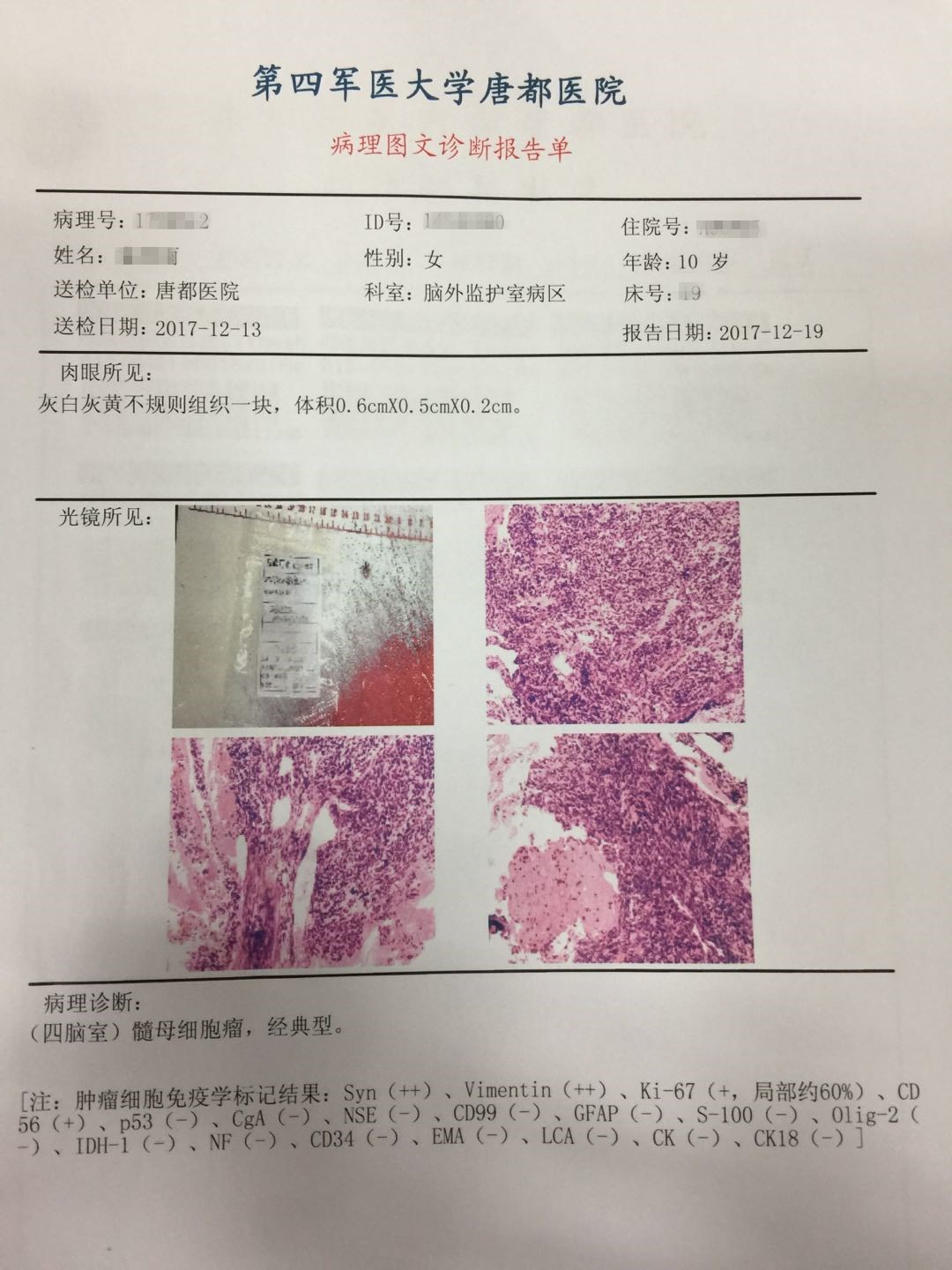 病理检查结果显示:四脑室髓母细胞瘤,经典型   术后病理检查