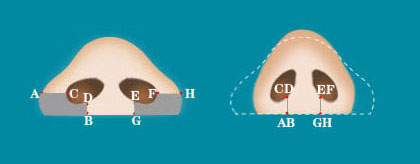 鼻翼及鼻基底联合整形术效果图