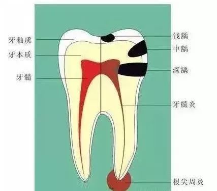 牙齿上的小黑点变黑洞?有那么可怕?