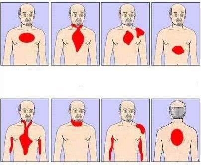 后背疼痛,查体身体健康,一切正常,为何突发心肌梗死!