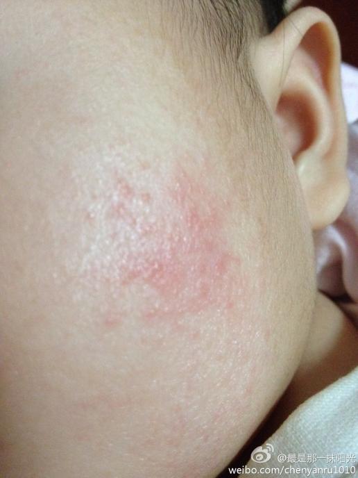 宝宝四个半月,脸上的属于湿疹吗?之前一直有,用过皮