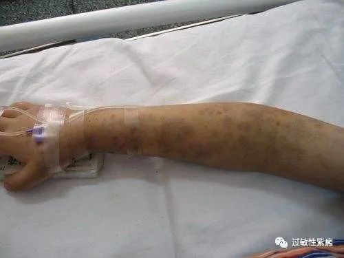 但过敏性紫癜患者一般表现出血小板计数正常或升高,凝血功能也正常