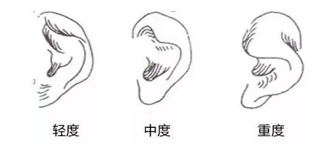 妈妈:揪一揪耳朵,就能治好杯状耳?