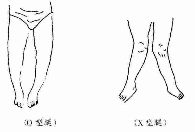 宝宝的x或o型腿到底正不正常需不需要补钙