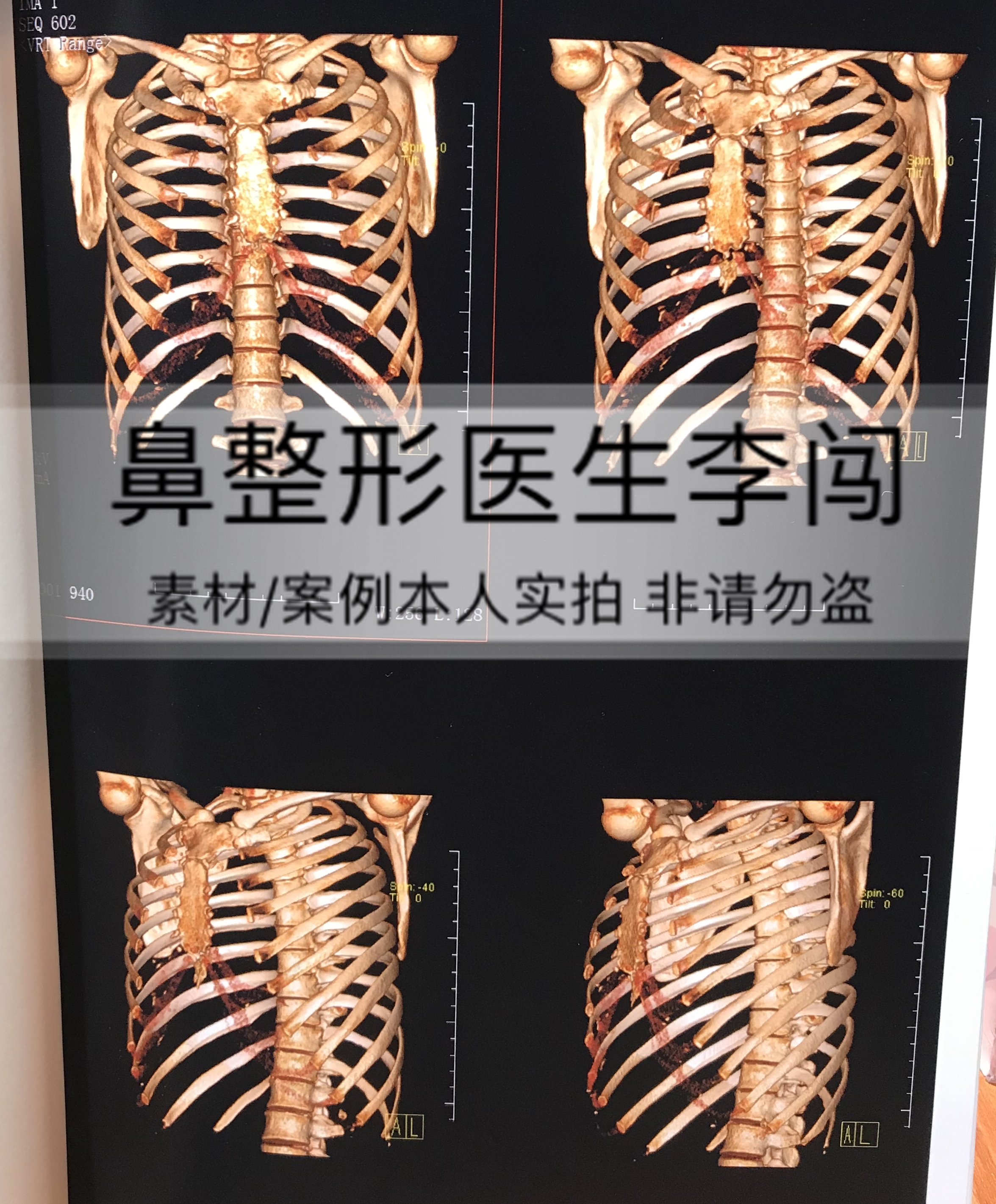 常规肋软骨三维重建片可观察到肋软骨是否钙化等
