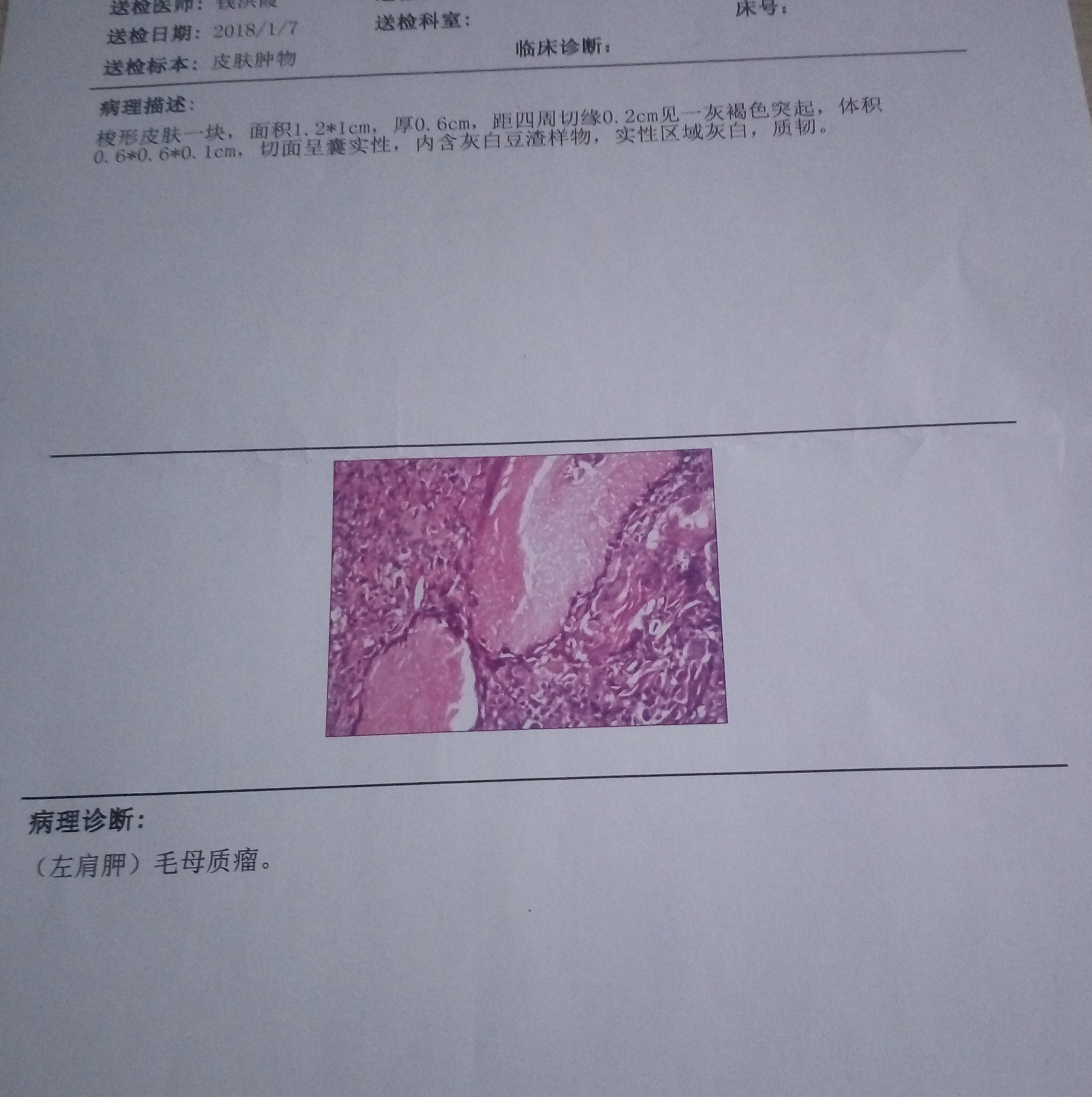 毛母质瘤1例