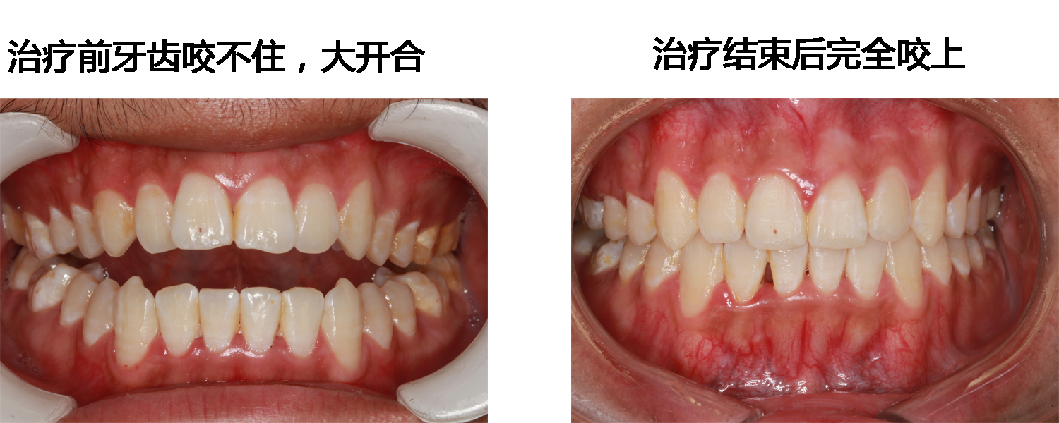 比如,前牙开合.