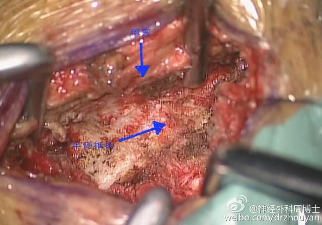 微创手术治疗 84岁高龄 腰椎管多发神经纤维瘤