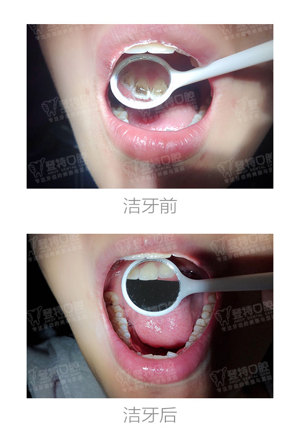 洗牙会伤害牙齿?三张图告诉你真相!