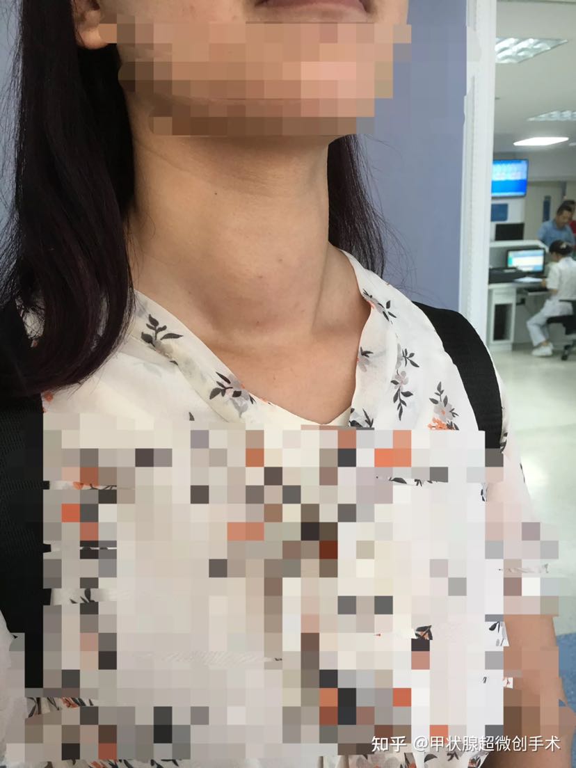 甲亢微创消融治疗是怎么回事