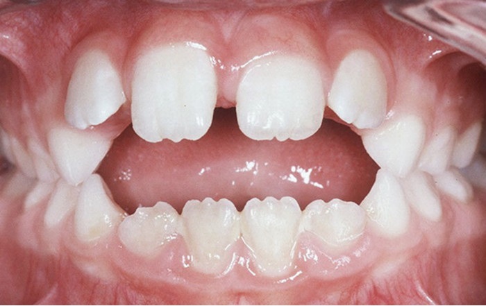 儿童一般哪些情况需要提前矫正牙齿?