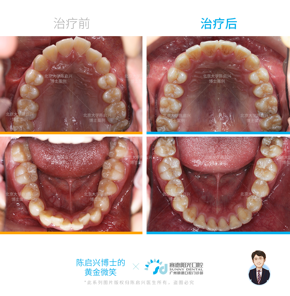 腺样体面容 兔牙 深覆盖矫正案例