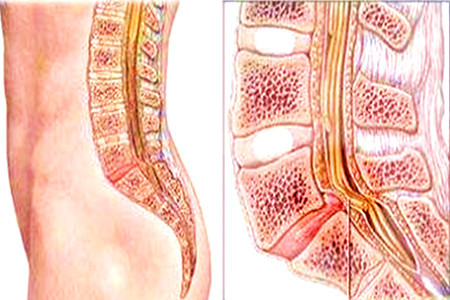 脊柱裂通常分为显性脊柱裂和隐性脊柱裂.