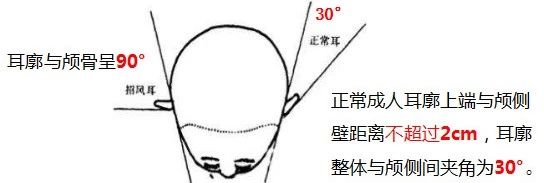 突起部位的耳轮不卷曲 对耳轮上脚与耳轮间有异