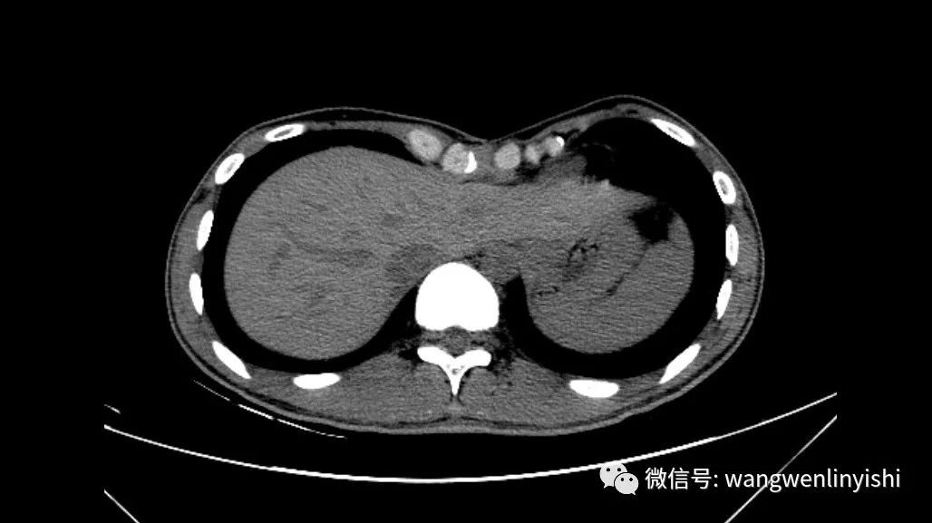 【提要】今天上午,我们为一例特殊的漏斗胸患者实施了第四次手术.