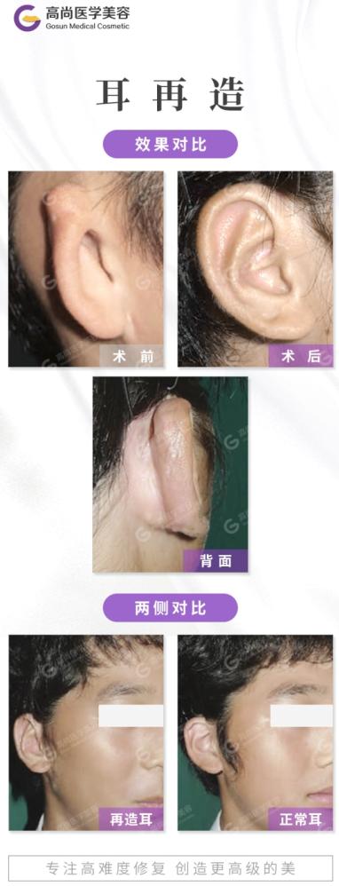 小耳畸形耳再造手术案例对比图