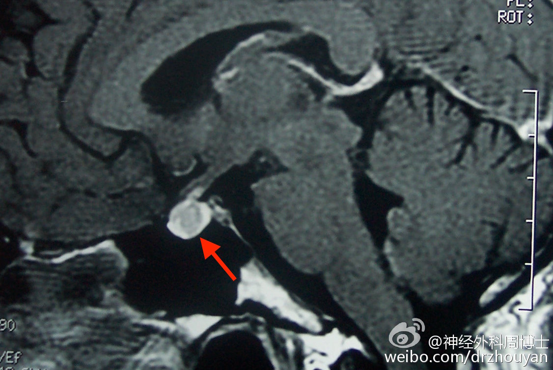 【临床病例分析】鞍区rathke囊肿的诊断及治疗方案