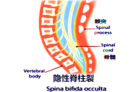 患上脊柱裂该怎样治疗