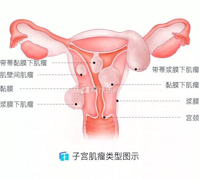 程亚辉科普:子宫肌瘤的原因及症状