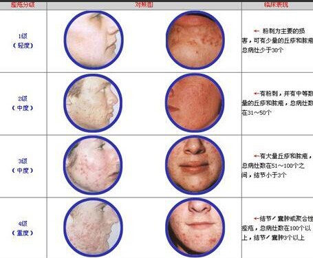一张图搞定痤疮的分级.