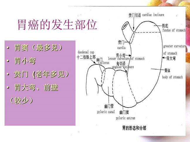 胃癌的病理分型你知道多少?