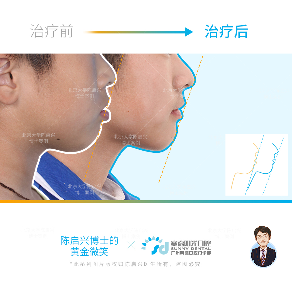 腺样体面容 嘴突 深覆盖 门牙缝过大矫正案例