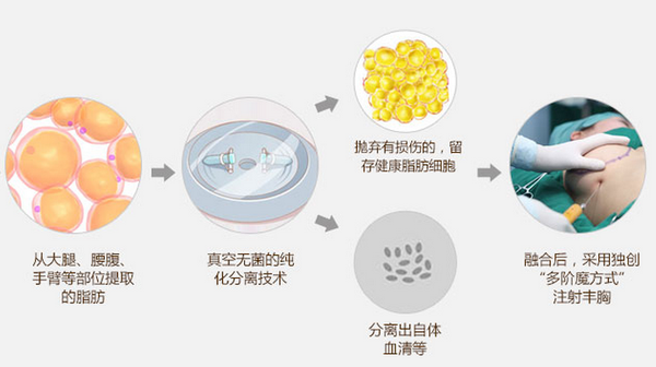 自体脂肪隆胸注意事项 自体脂肪移植隆胸优势