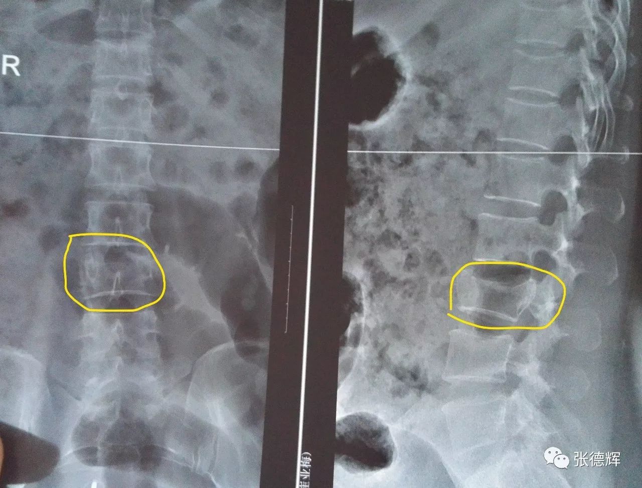 术前x光片,可见第3腰椎压缩变扁,上终板损伤