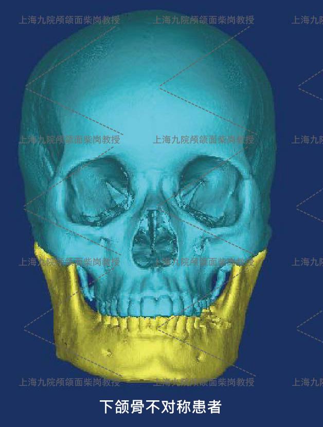 下颌角骨骼外扩,折点过低.下颌骨肥大患者1.下颌角骨骼肥大,非软组织.