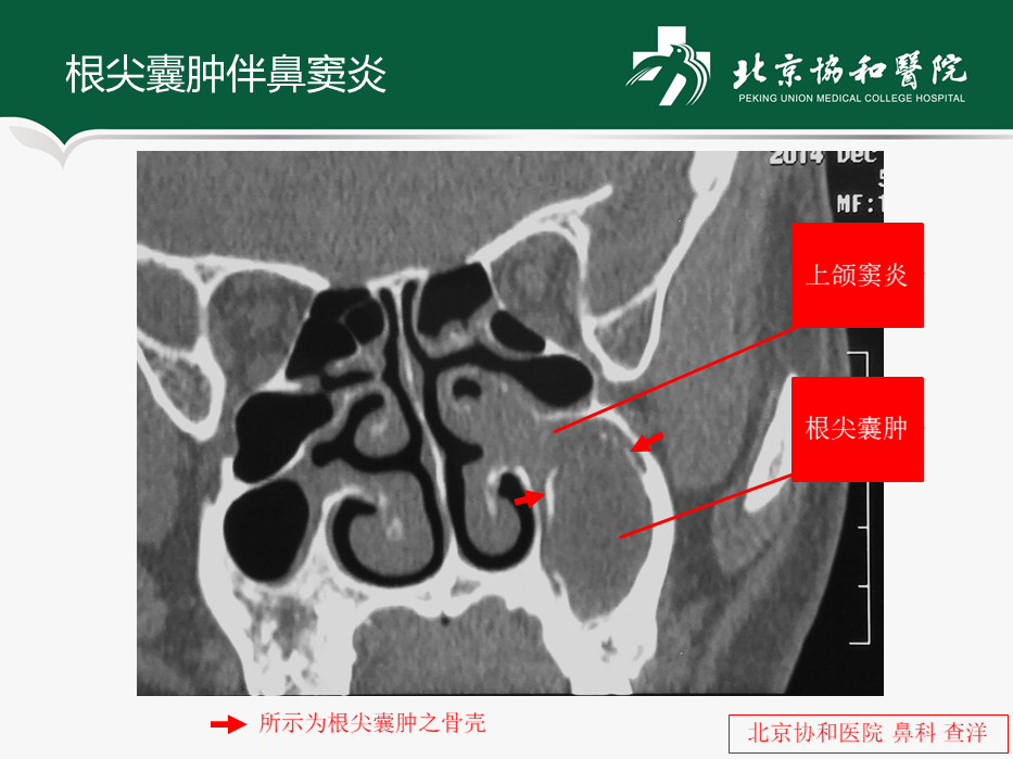 鼻窦囊肿是否都需要做手术