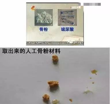 3,爱贝芙爱贝芙被宣称是长期玻尿酸.