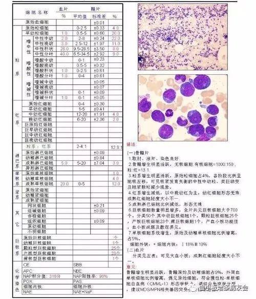 怎么知道得了原发性血小板增多症?谢别录工作室整理