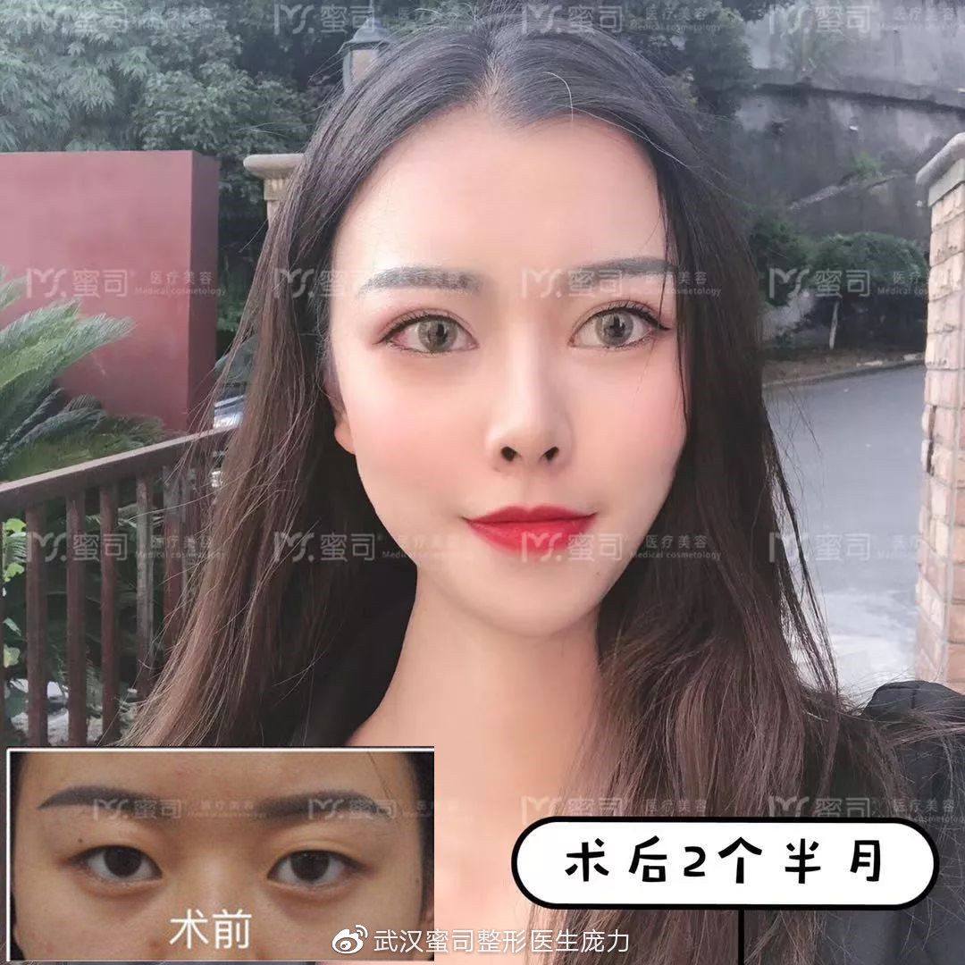 如果你也想要拥有同款平行双眼皮, 变身人间芭比, 不如先来我们蜜