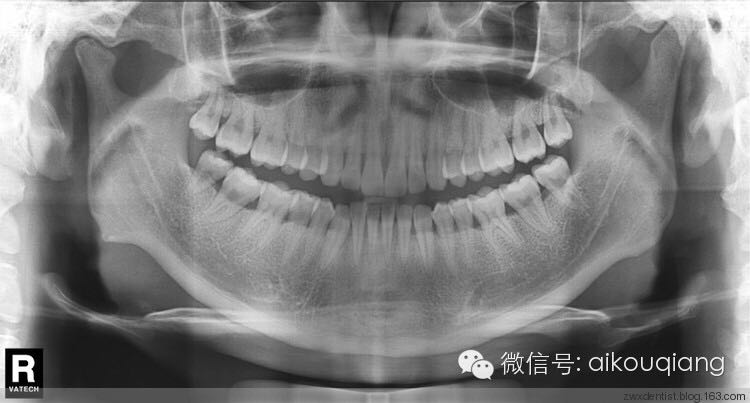 x光片上可以显示出,患者牙槽骨因长期的炎症刺激,吸收比较多.