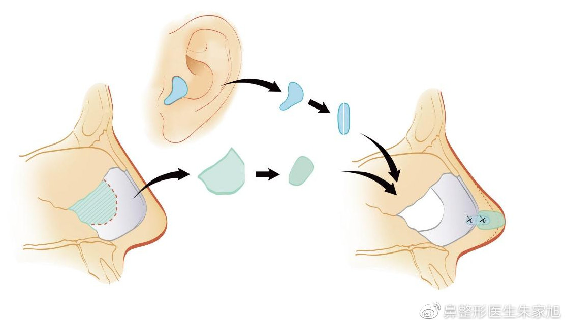 挛缩鼻产生的原因,该如何避免隆鼻后包膜挛缩现象?